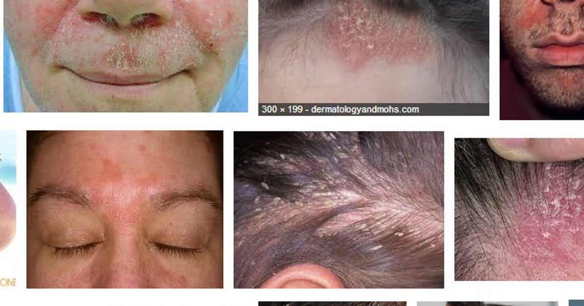 Seborrheic Dermatitis Hair Loss Temporary Washington Dc Aboutme