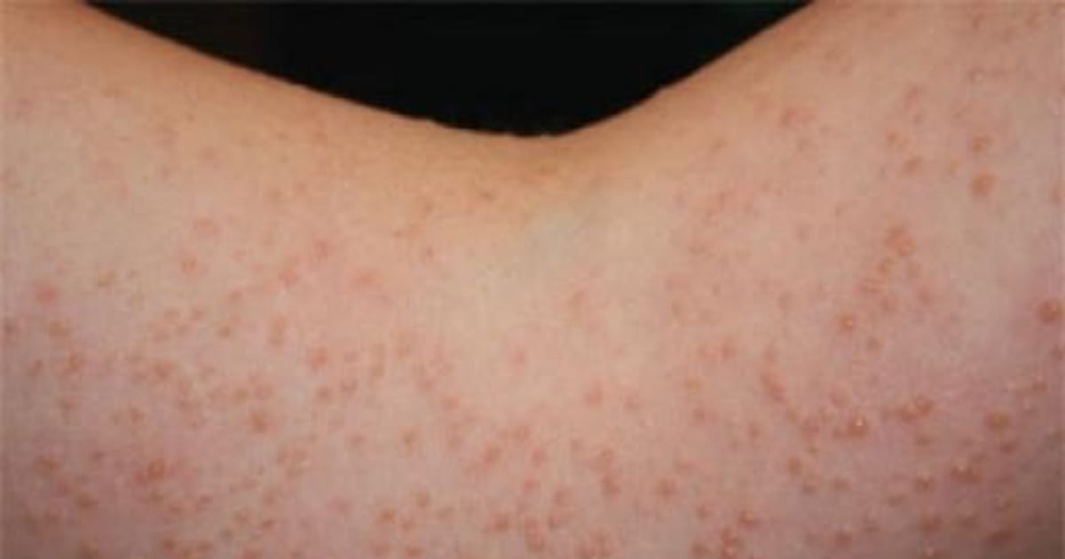 Sun Poisoning Nyc Department of Education about.me